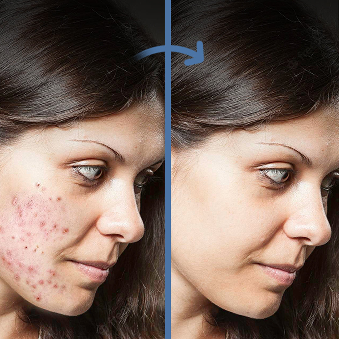 Portable Micro Bubble Electric Facial Cleaner, Blackhead Remover