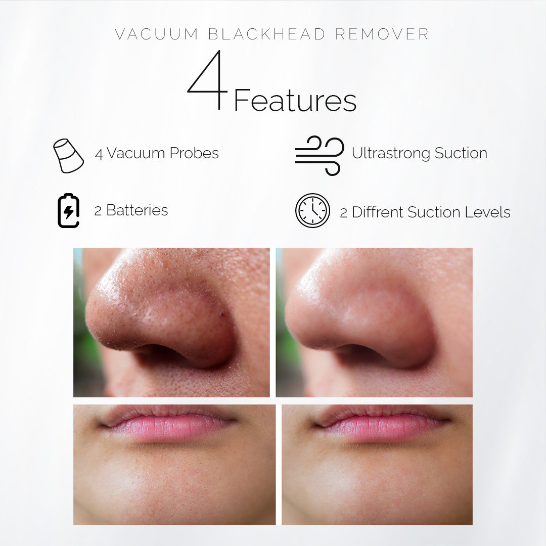Blackhead Remover Vacuum Suction Pore Cleaner